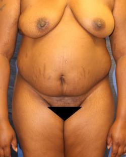 After Results for Tummy Tuck