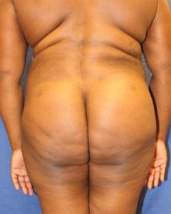 After Results for Gluteal Augmentation