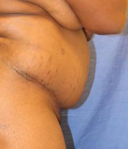 After Results for Tummy Tuck