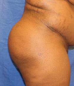 After Results for Gluteal Augmentation