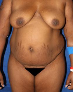 Before Results for Tummy Tuck