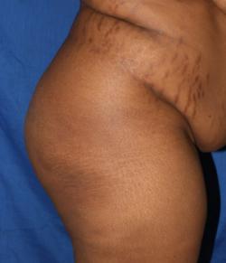 Before Results for Tummy Tuck