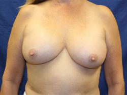 After Results for Breast Augmentation