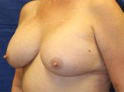 After Results for Breast Augmentation, Implant Exchange and Removal 	