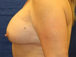 After Results for Breast Augmentation