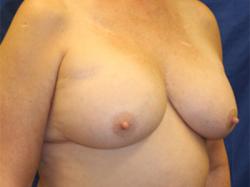 After Results for Breast Augmentation