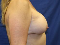 After Results for Breast Augmentation