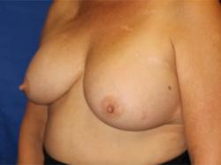 Before Results for Breast Augmentation, Implant Exchange and Removal