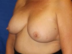 Before Results for Breast Augmentation, Implant Exchange and Removal 	