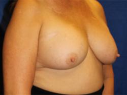 Before Results for Breast Augmentation