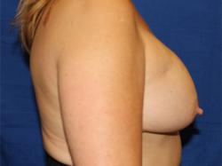 Before Results for Breast Augmentation