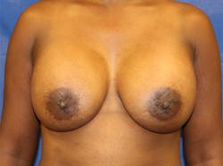 After Results for Breast Augmentation