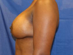 After Results for Breast Augmentation