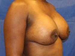 After Results for Breast Augmentation