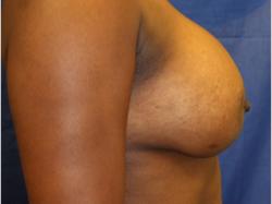 After Results for Breast Augmentation
