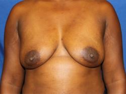 Before Results for Breast Augmentation