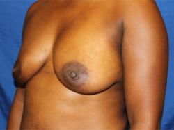 Before Results for Breast Augmentation