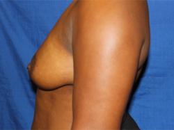 Before Results for Breast Augmentation
