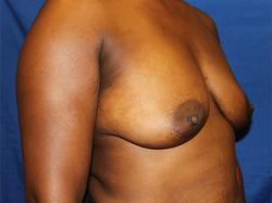 Before Results for Breast Augmentation