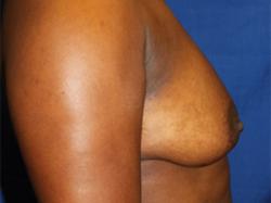 Before Results for Breast Augmentation