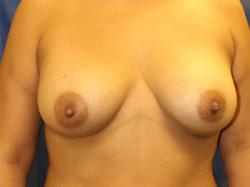 After Results for Breast Augmentation
