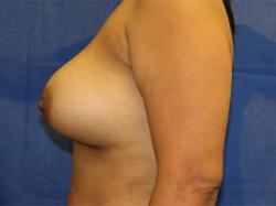 After Results for Breast Augmentation