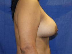 After Results for Breast Augmentation