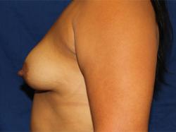 Before Results for Breast Augmentation