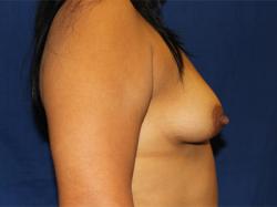 Before Results for Breast Augmentation