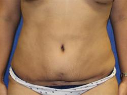 After Results for Tummy Tuck