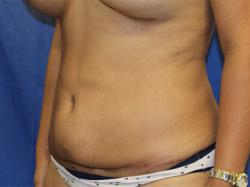 After Results for Tummy Tuck