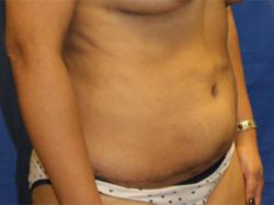 After Results for Tummy Tuck