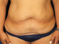 Before Results for Tummy Tuck