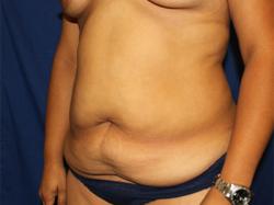 Before Results for Tummy Tuck