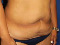 Before Results for Tummy Tuck