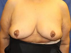 After Results for Breast Reduction