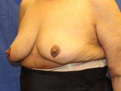 After Results for Breast Reduction