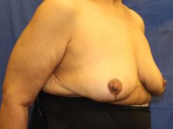 After Results for Breast Reduction