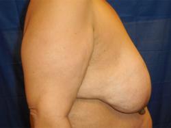 Before Results for Breast Reduction