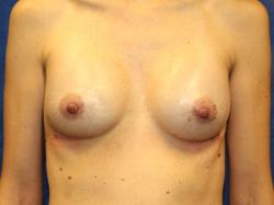 After Results for Breast Augmentation