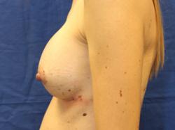 After Results for Breast Augmentation