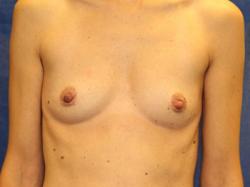 Before Results for Breast Augmentation