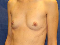 Before Results for Breast Augmentation