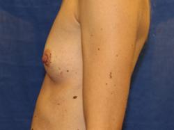 Before Results for Breast Augmentation