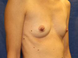 Before Results for Breast Augmentation
