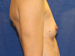 Before Results for Breast Augmentation