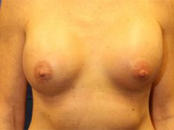 After Results for Breast Augmentation