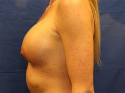 After Results for Breast Augmentation
