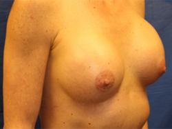 After Results for Breast Augmentation