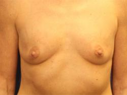 Before Results for Breast Augmentation